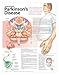 Understanding Parkinson's Disease Anatomical Chart