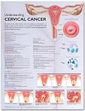 Chart -Understanding Cervical Cancer Anatomical Chart- Plastic Laminated