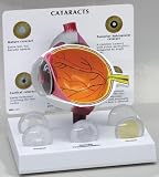 Cataract Eye, Anatomical Model, Set of 5 Interchangeable Lens