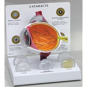 Cataract Eye, Anatomical Model, Set of 5 Interchangeable Lens