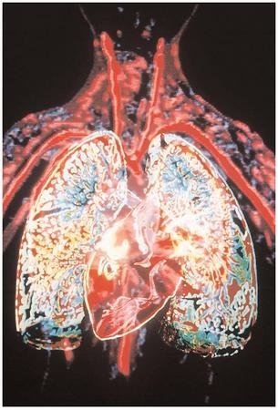 Congestive-Heart-Failure