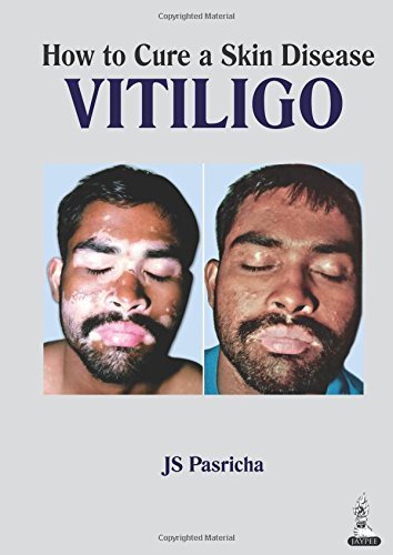 How to Cure a Skin Disease: Vitiligo 1st edition by Pasrica, J. S., M.D., Ph.D. (2014) Paperback