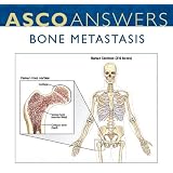 Bone Metastasis Fact Sheet (pack of 125 fact sheets)