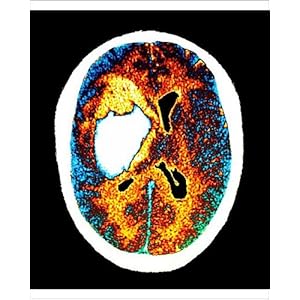 Stroke+ct+scan+images