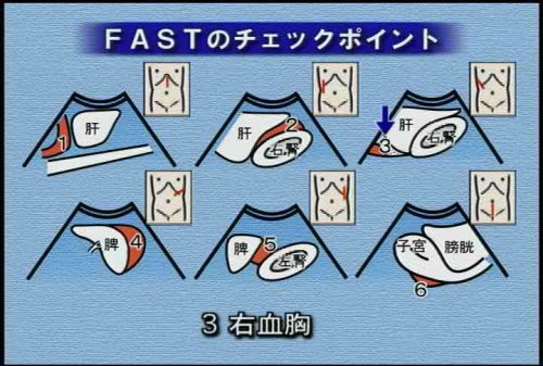 “の”の字2回走査法で出来る! 超音波手技大原則〈第3巻〉 ケアネットDVD