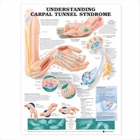 Click here to buy Understanding Carpal Tunnel Syndrome Anatomical Chart 20 X 26 Laminated.