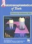 Autotransplantation of Teeth