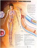 Deep Vein Thrombosis Anatomical Chart