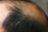 Attention: To Everyone Who is Concerned About Hair Loss
