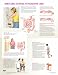 Book Irritable Bowel Syndrome Chart (Netter Charts)