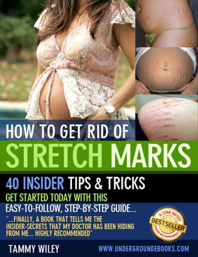how to get rid of stretch marks