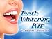 Teeth Whitening