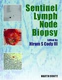 Sentinel Lymph Node Biopsy