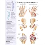 Understanding Arthritis Anatomical Chart