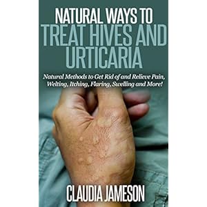 Natural Ways to Treat Hives and Urticaria: Natural Methods to Get Rid of and Relieve Pain, Welting, Itching, Flaring, Swelling and More! (skin care, s
