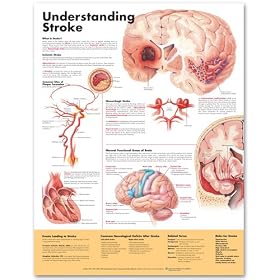 Click here to buy Understanding Stroke 2nd Edition Anatomical Chart - Laminated by Anatomical Chart Company.