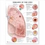 Diseases of the Lung Anatomical Chart 20" X 26"