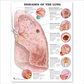 Diseases of the Lung Anatomical Chart 20" X 26"