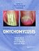 Books : Onychomycosis (Series in Dermatological Treatment)