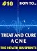 How To Treat And Cure Acne (Health Blueprints #10)