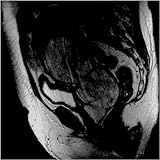 Carcinosarcoma [CD on Demand]