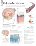 Understanding Migraines chart