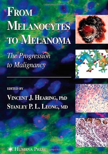 melanoma