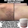 Vein Away Remove ugly Spider / Thread Veins! Pain Free and Quick!