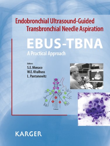 Endobronchial Ultrasound-Guided Transbronchial Needle Aspiration (EBUS-TBNA): A Practical Approach