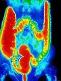 Female GI Tract Enhanced Radiograph Photographic Poster Print, 24x32