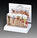 Diseased Teeth and Gums Model