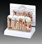 Diseased Teeth and Gums Model