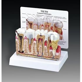 Diseased Teeth and Gums Model