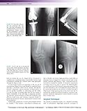 Techniques in Revision Hip and Knee Arthroplasty, 1e Techniques in Revision Hip and Knee Arthroplasty, 1e
