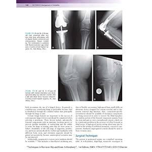 Techniques in Revision Hip and Knee Arthroplasty, 1e