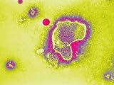 Respiratory Syncytial Virus Rsv Infection Photographic Poster Print, 24x18
