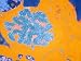Lymph Node from Male Lymphoblastic T-Cell X5000 Photographic Poster Print, 16x12