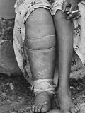 Samoan Woman with Elephantiasis Photographic Poster Print by Carl Mydans, 24x32