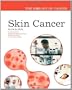 Skin Cancer (Biology of Cancer)