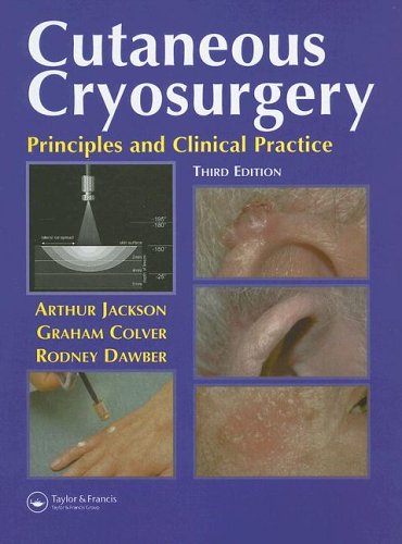 Cutaneous Cryosurgery: Principles and Clinical Practice, Third Edition