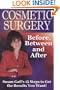 Cosmetic Surgery: Before, Between and After