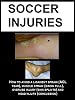 SOCCER INJURIES: HOW TO AVOID A LIGAMENT SPRAIN (ACL TEAR), MUSCLE STRAIN (GROIN PULL), OVERUSE INJURY (SHIN SPLINTS) AND HEAD INJURY (CONCUSSION)
