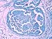 Comedo Carcinoma Breast Photomicrograph Cancer Photographic Poster Print, 16x12