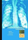Clinical tuberculosis