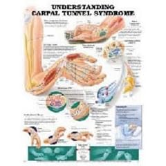 Click here to buy Understanding Carpal Tunnel Syndrome Anatomical Chart by Anatomical Chart Company.
