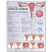 Understanding Cervical Cancer Anatomical Chart- Paper unmounted