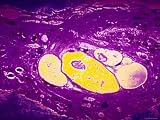 Cervical Cancer X400 Mag Vaculated Epithelium Photographic Poster Print, 16x12