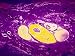 Cervical Cancer X400 Mag Vaculated Epithelium Photographic Poster Print, 16x12