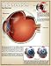 Eye Disorders Subject Art Poster Print, 17x22