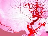Aneurysm Brain Vessels Cerebral Blood Burst Vein Photographic Poster Print, 18x24